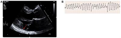 Mitral annular disjunction: A case series and review of the literature